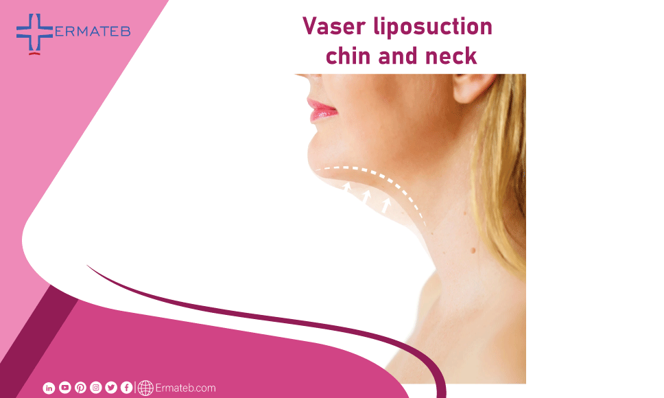 vaser liposuction chin and neck